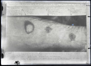Expérience de brûlures provoquées par une goutte d'ypérite sur un bras.